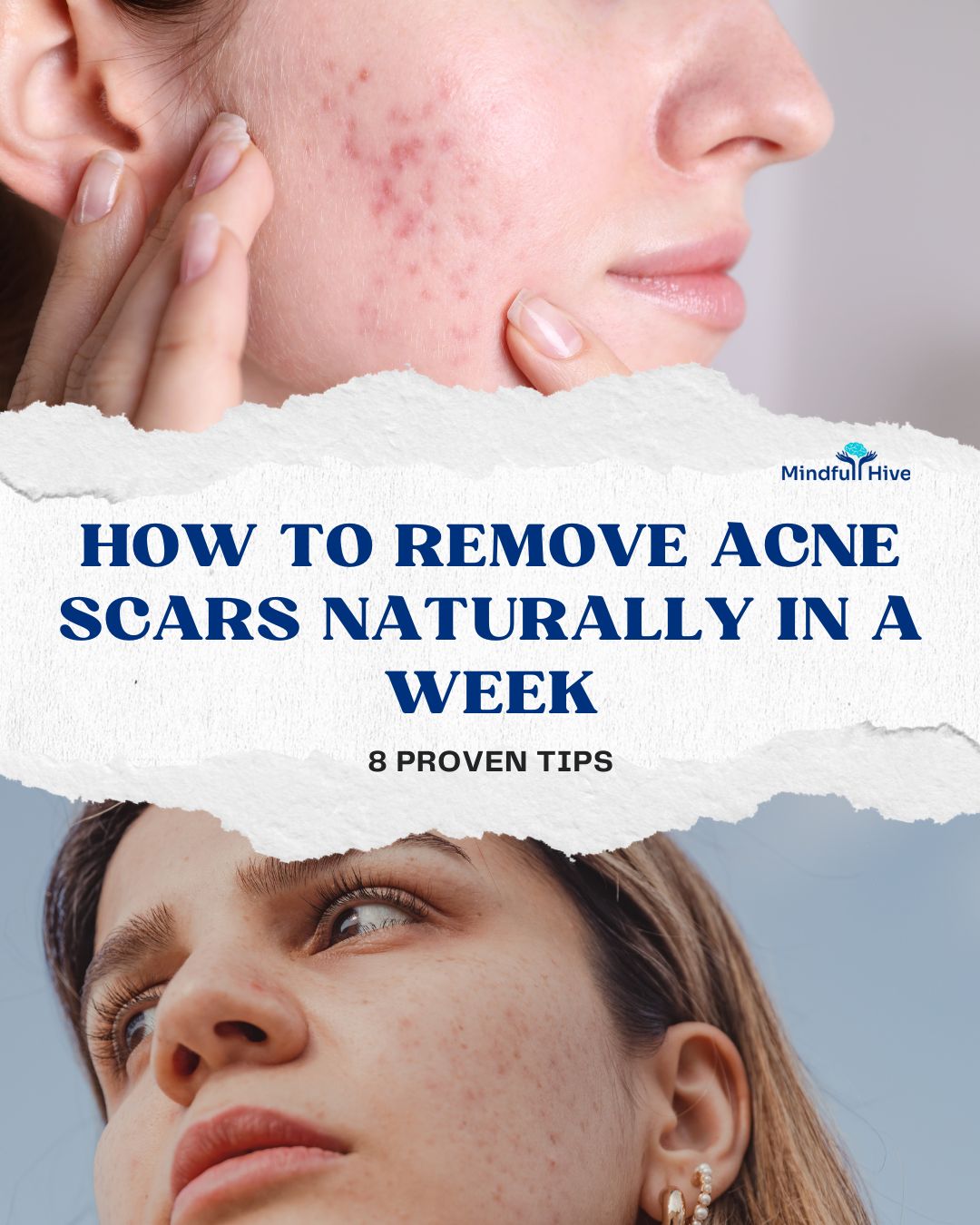 How to Remove Acne Scars Naturally in a Week